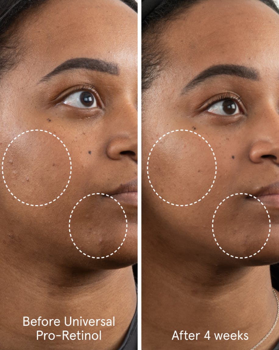 Model shot showing unretouched photos of before and after four weeks of using Universal Pro-Retinol