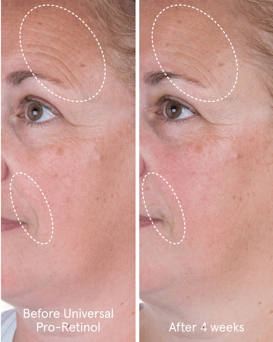 Model shot showing unretouched photos of before and after four weeks of using Universal Pro-Retinol